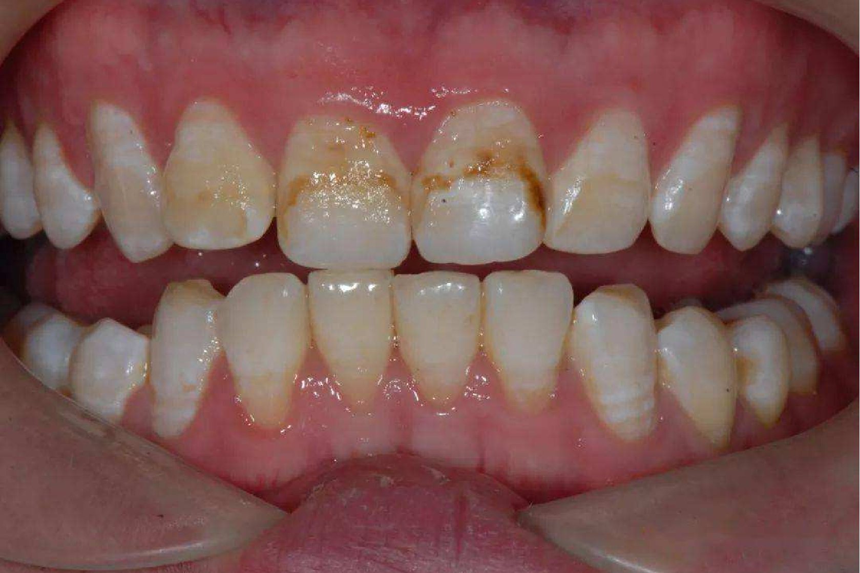 电镜扫描则可见横纹处孔隙增多,晶体排列混乱,相邻的两条生长线之间有