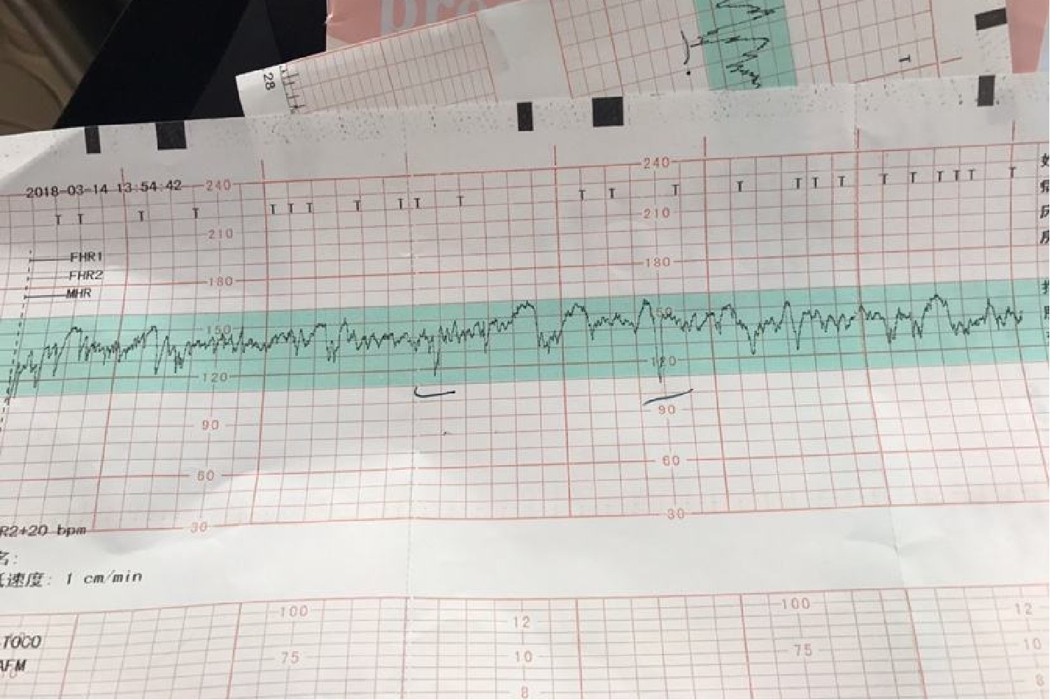 胎儿脐带受压形图