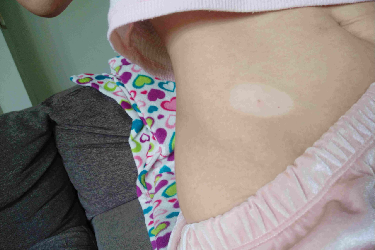 肚脐眼周围有白斑图片