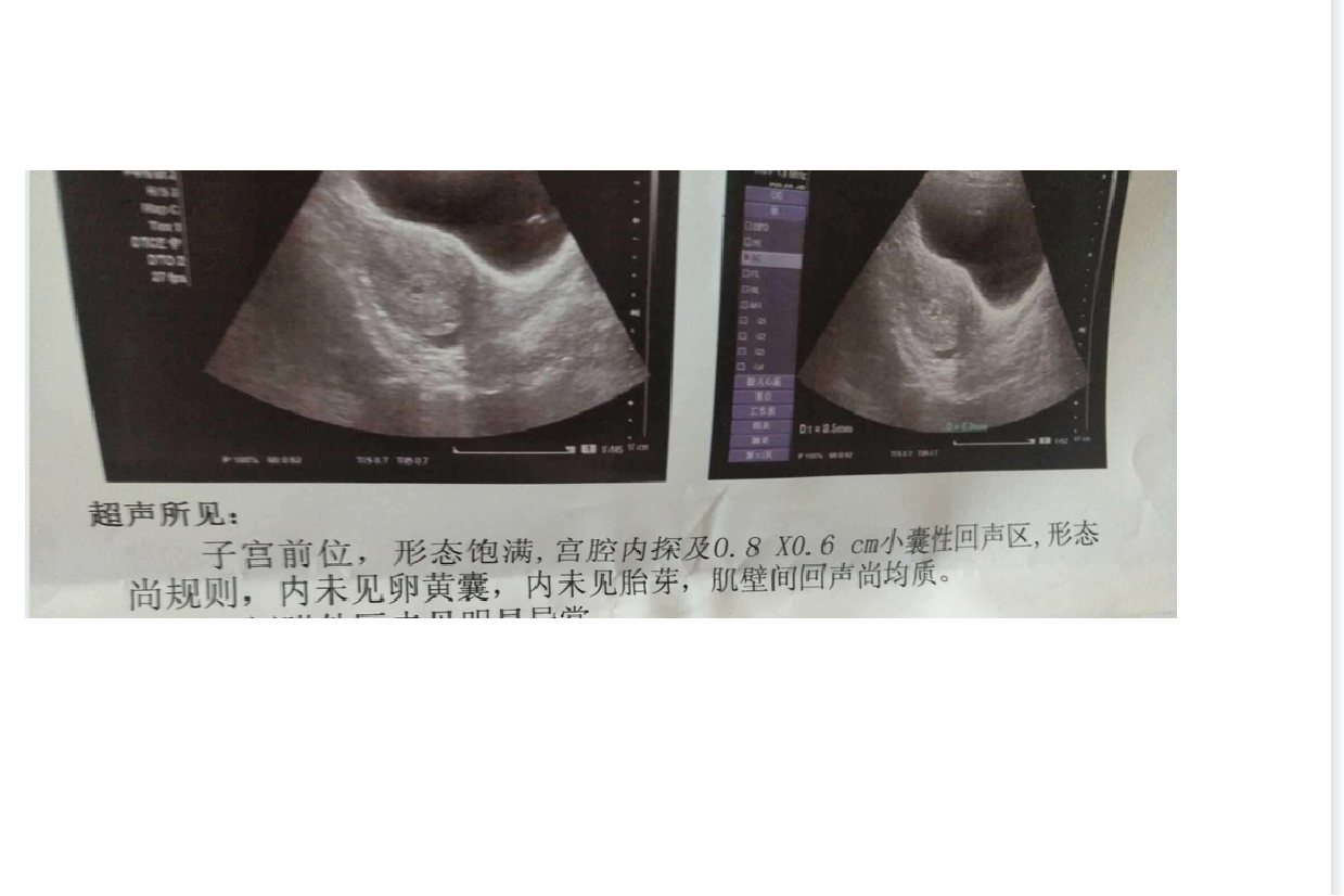 怀孕38天孕囊大小图