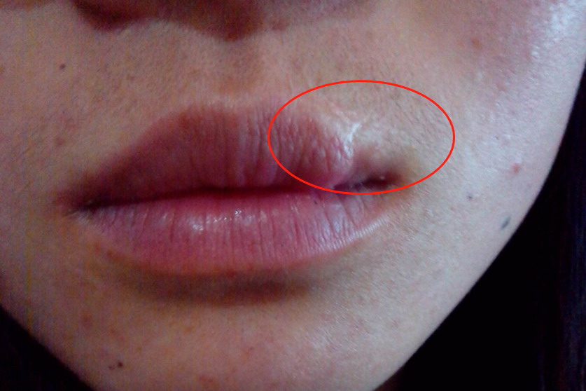 嘴唇黏膜增生图片图片