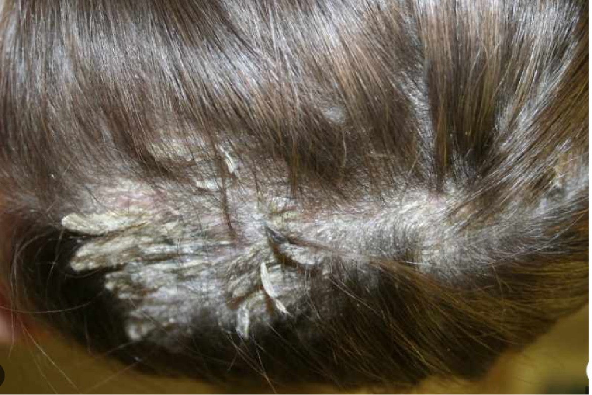 女性银屑病头发的图片