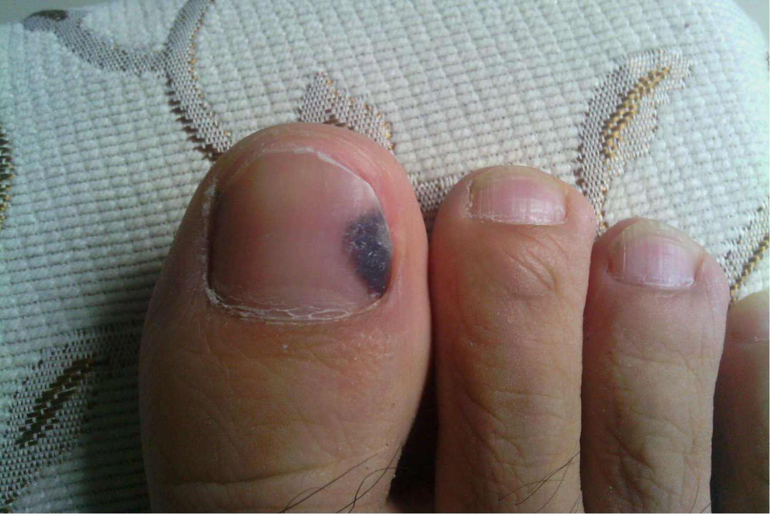 良性甲下黑色素瘤图片