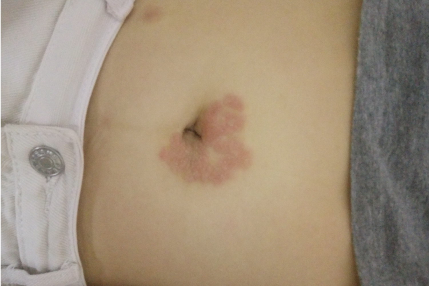 肚脐旁边有一圈红图