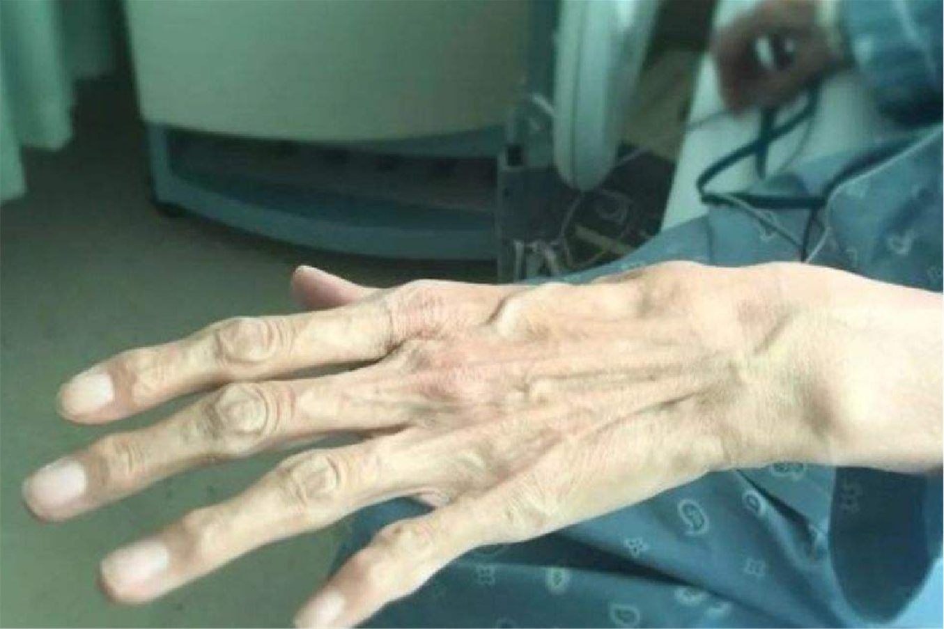 马凡氏综合征图片