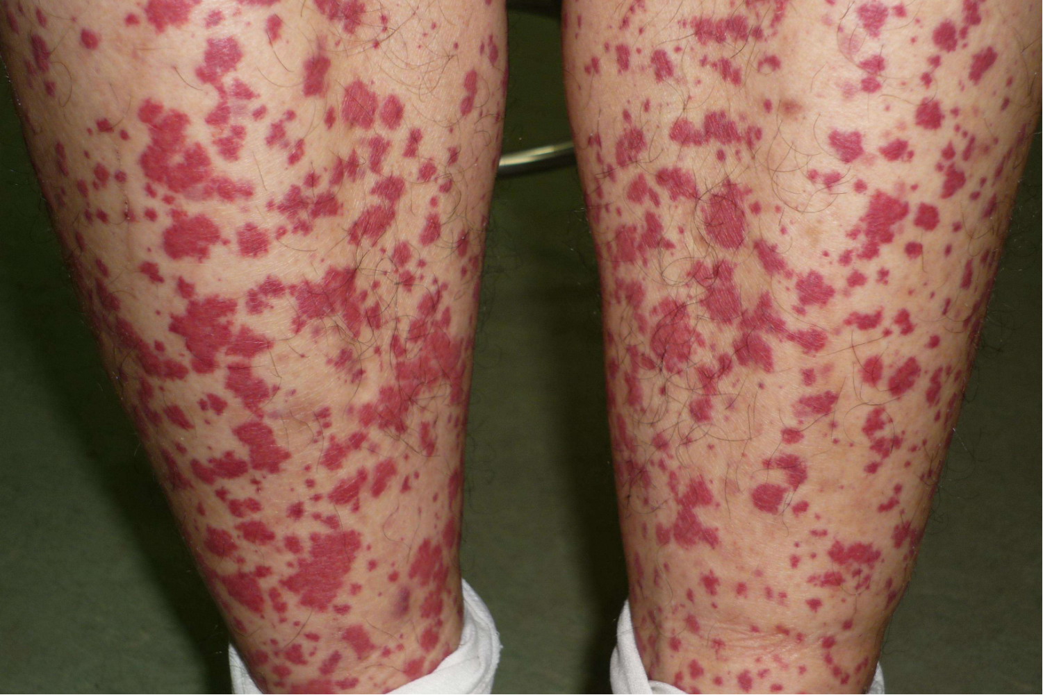 暴发性紫癜图片