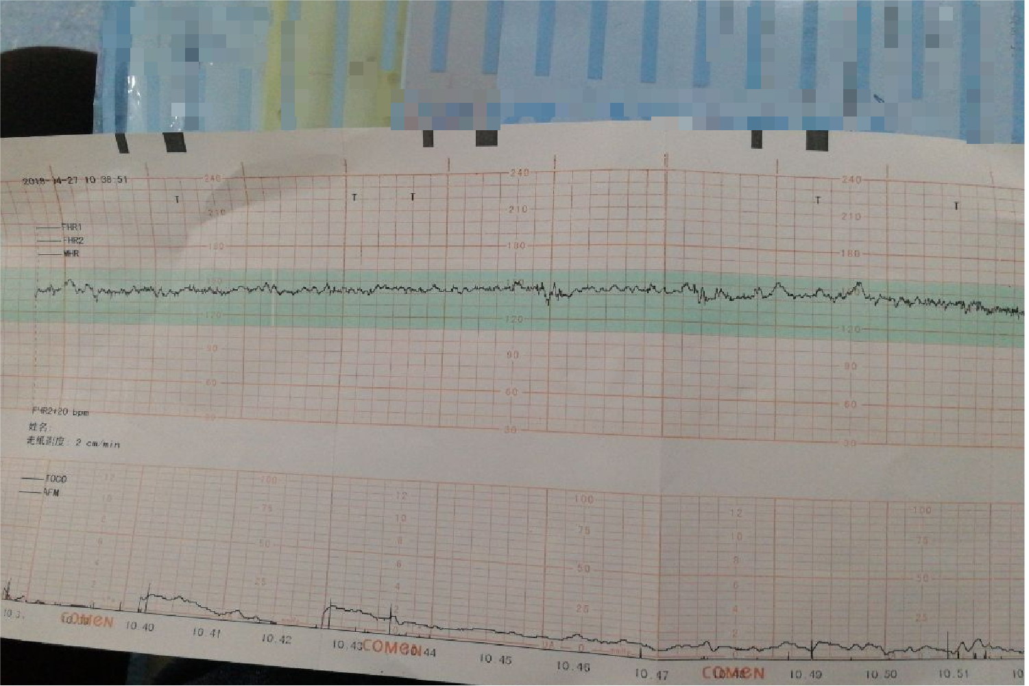 胎心监护曲线波动小图