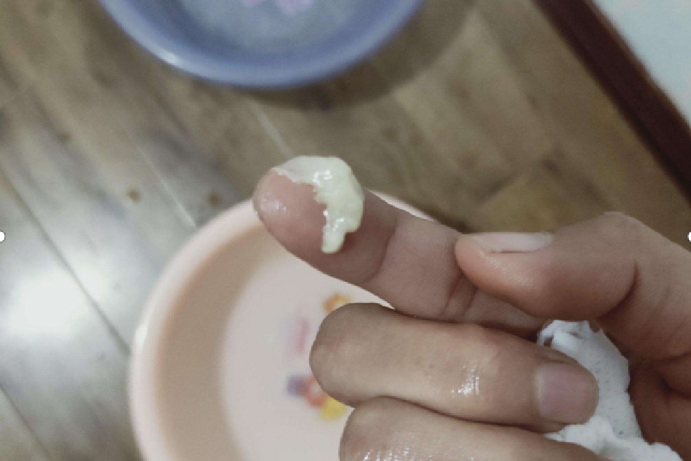 乳酪样白带分泌物图