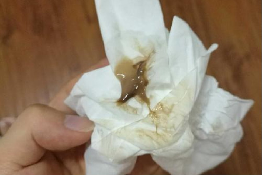 孕早期褐色鼻涕状分泌物图