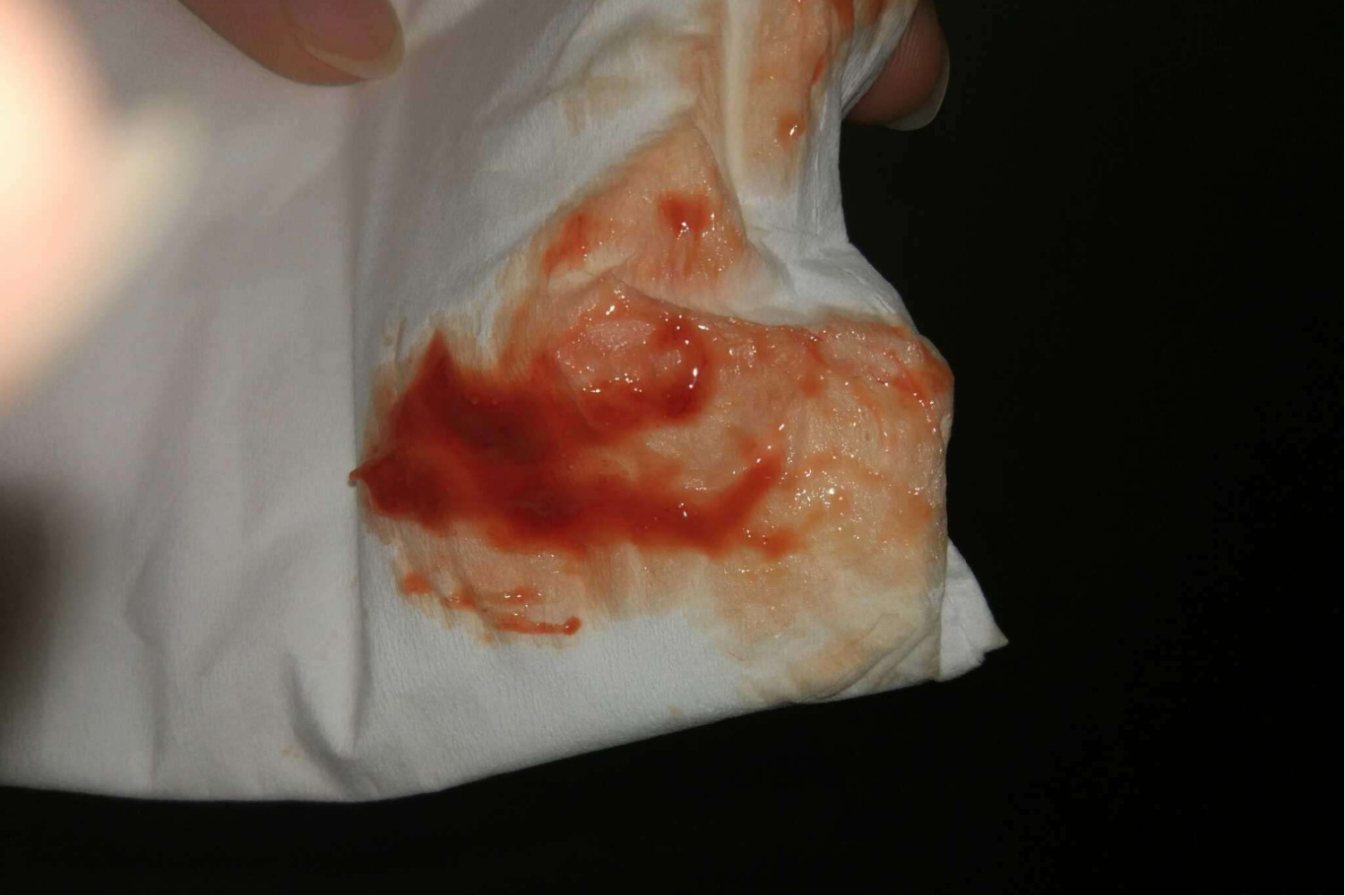 产后脓性分泌物图