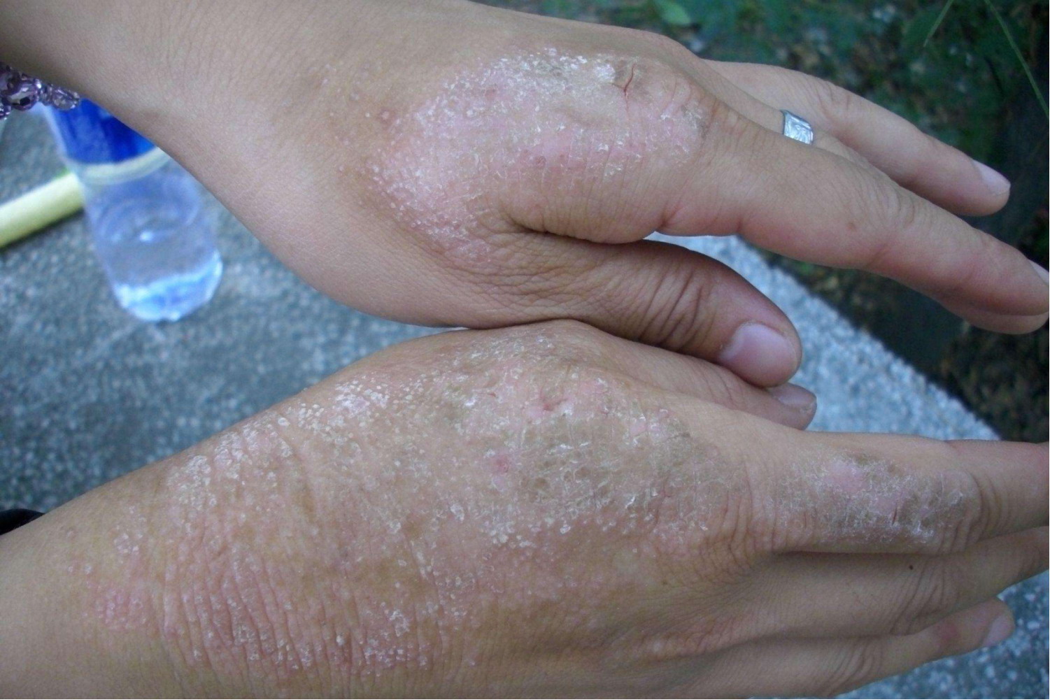 皮肤脱屑潮红痒图片