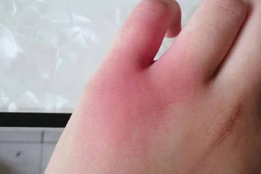 手被洋辣子蛰了图