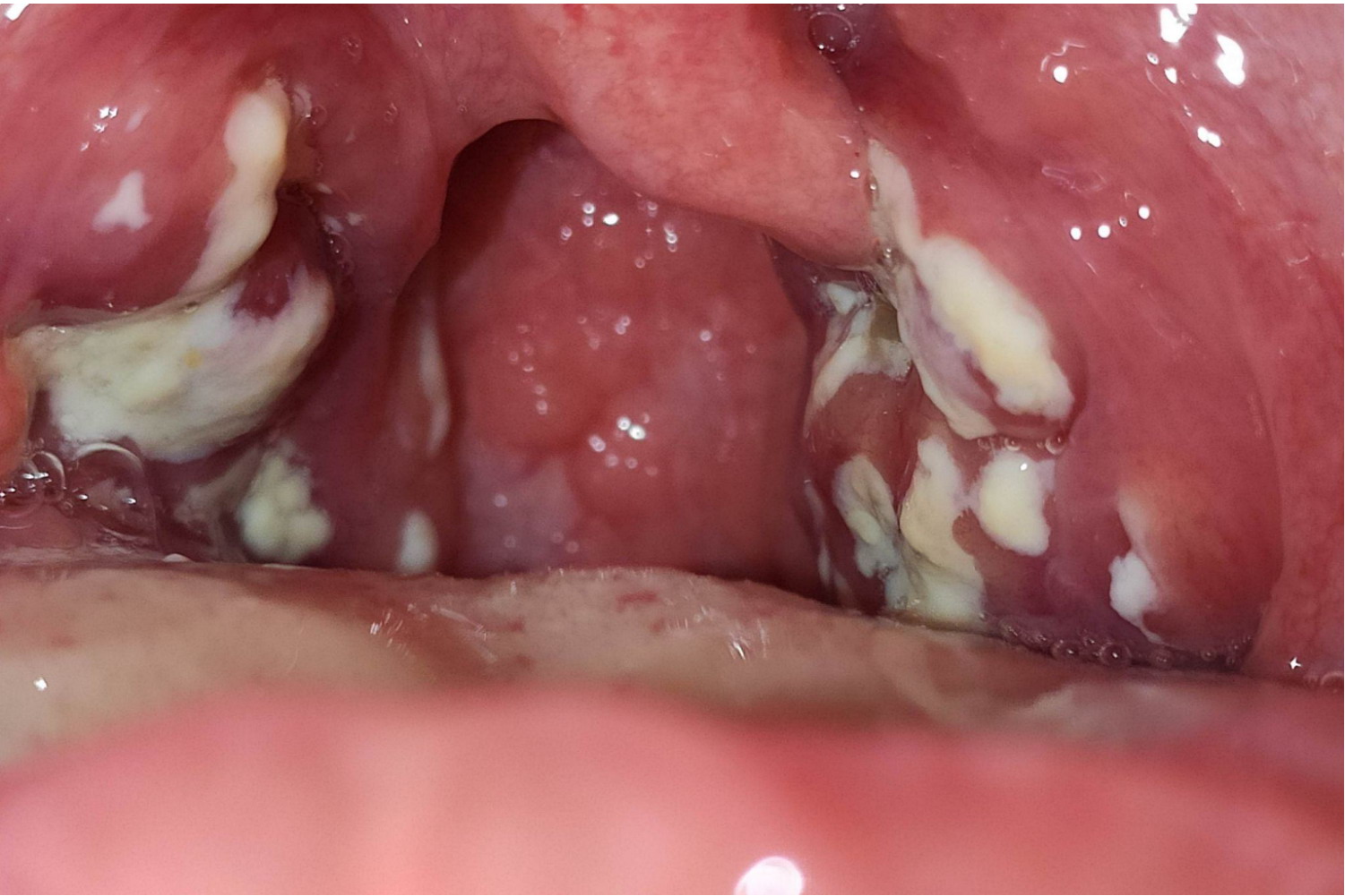 扁桃体发炎化脓图
