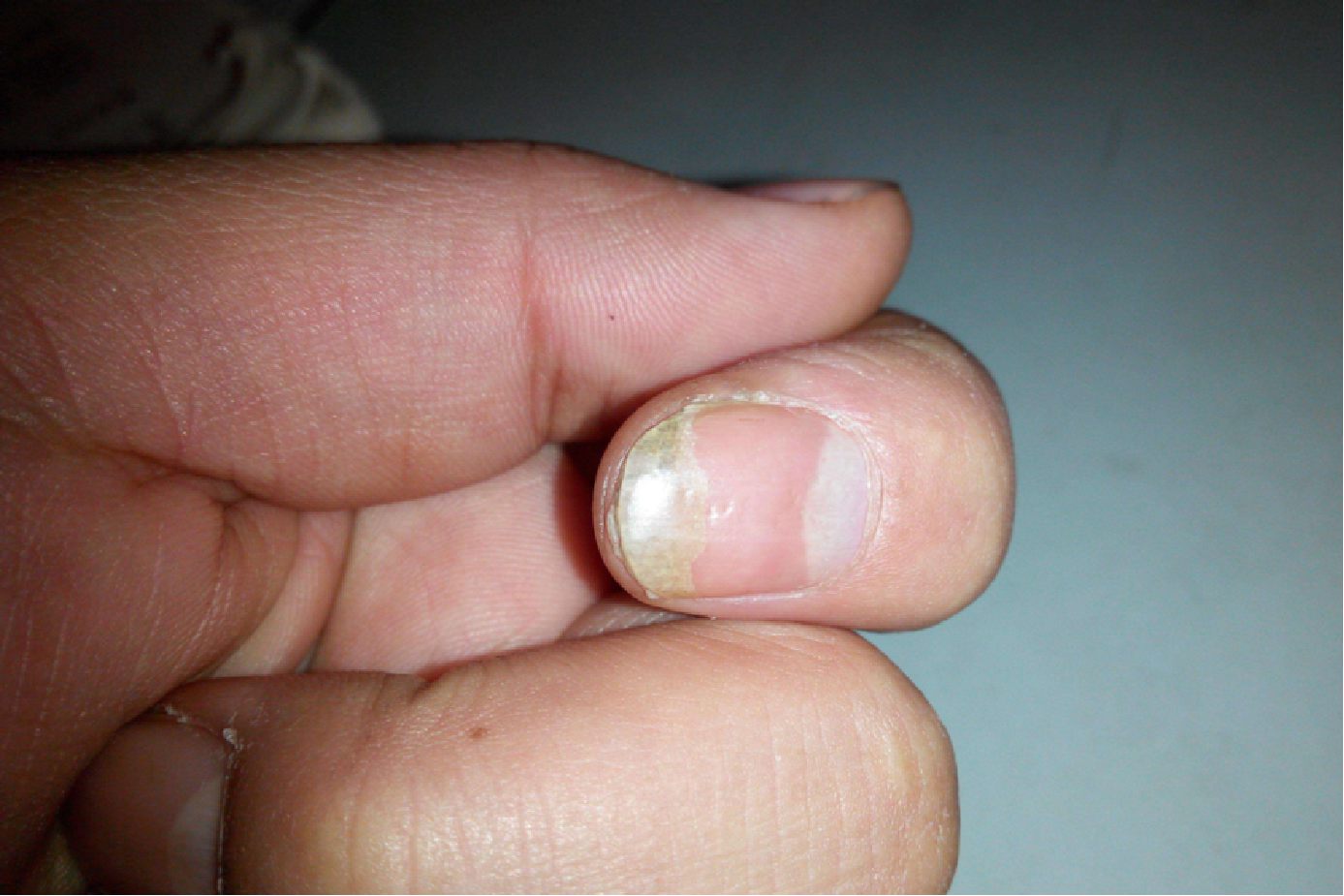 手指甲钙化图
