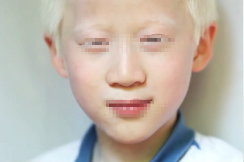 中国白化病人图