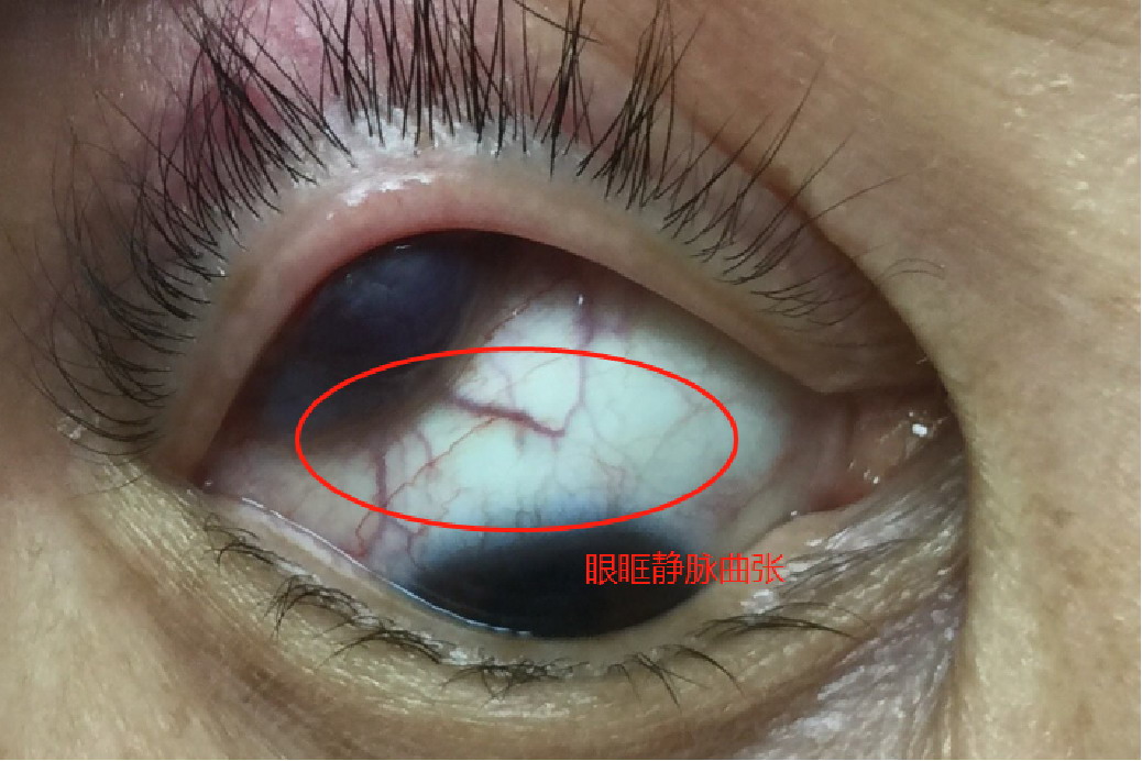 眼眶静脉曲张图