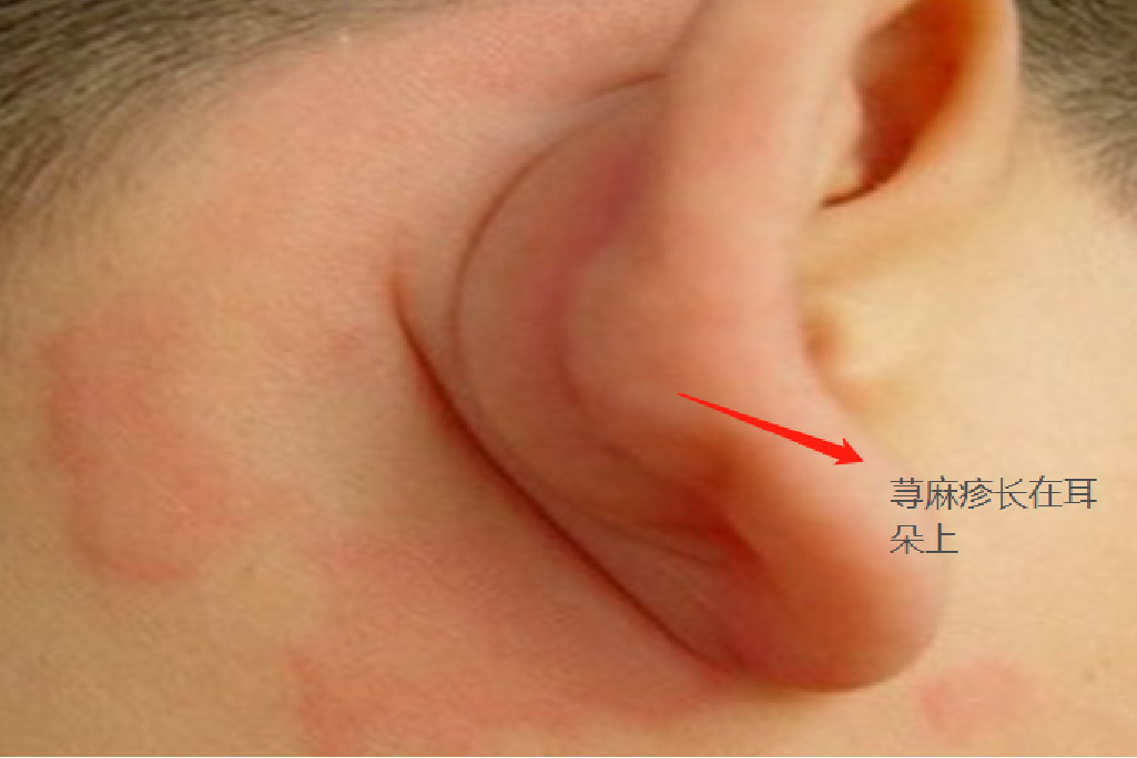 荨麻疹长在耳朵上图