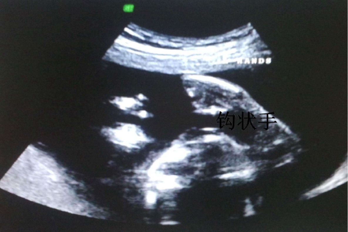 糖尿病致胎儿畸形图