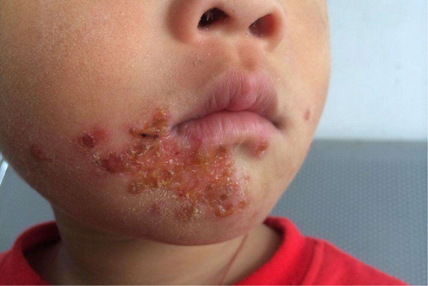 嘴角脓疱疮图片