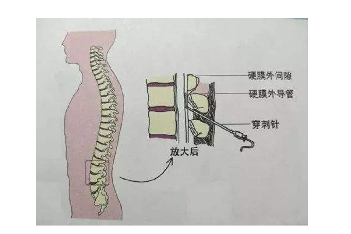 脊椎麻醉部位图片