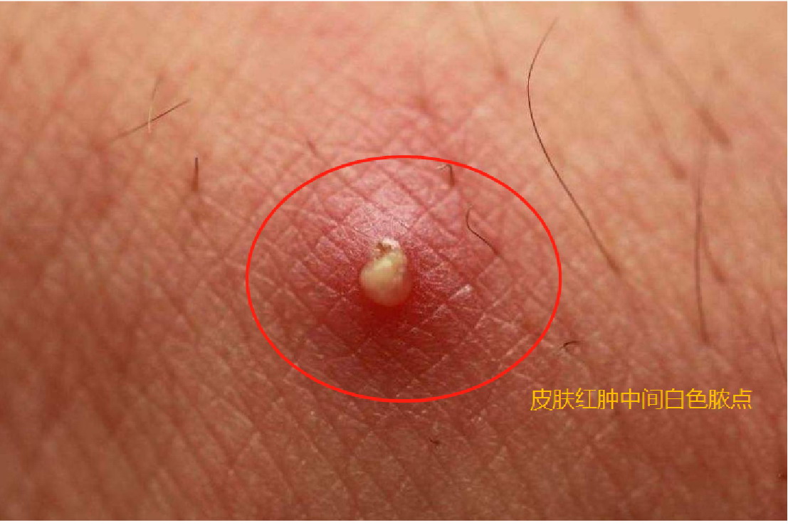 皮肤红肿中间白色脓点图