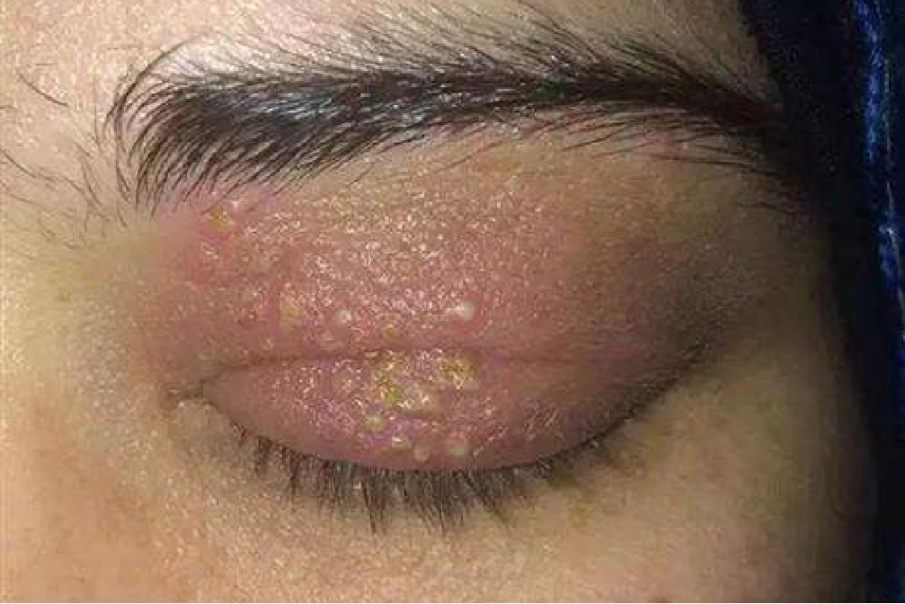 单纯疱疹眼睑炎图