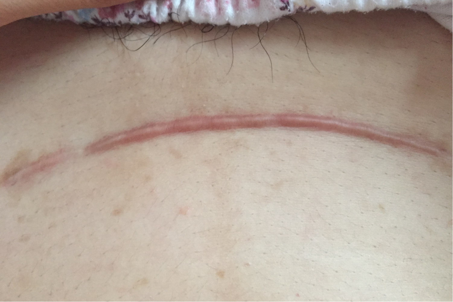 剖腹产三个月刀口增生图