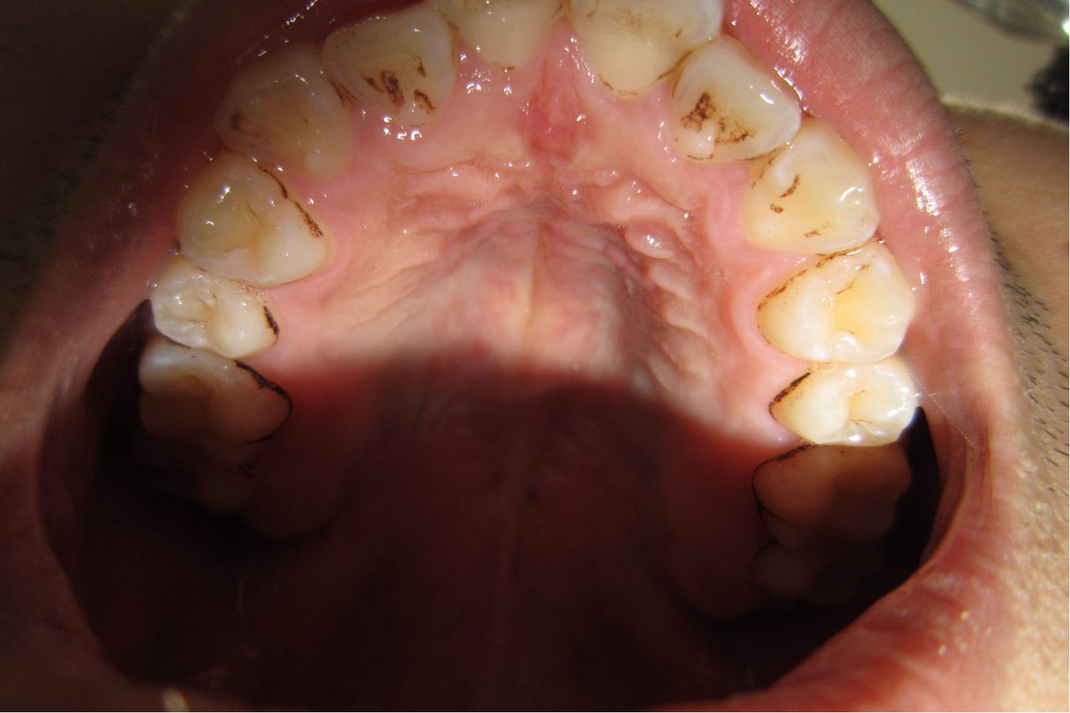 上门牙后面鼓起的软肉图