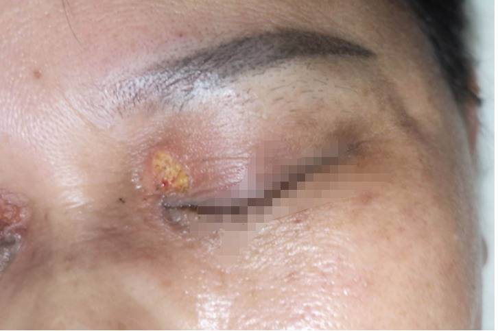 眼皮上长睑黄疣图