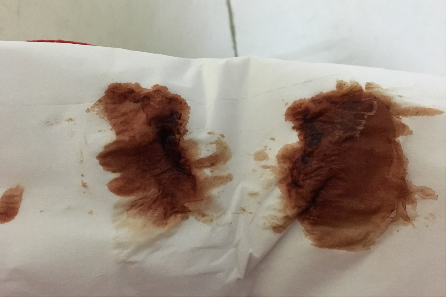 宫外孕褐色分泌物图