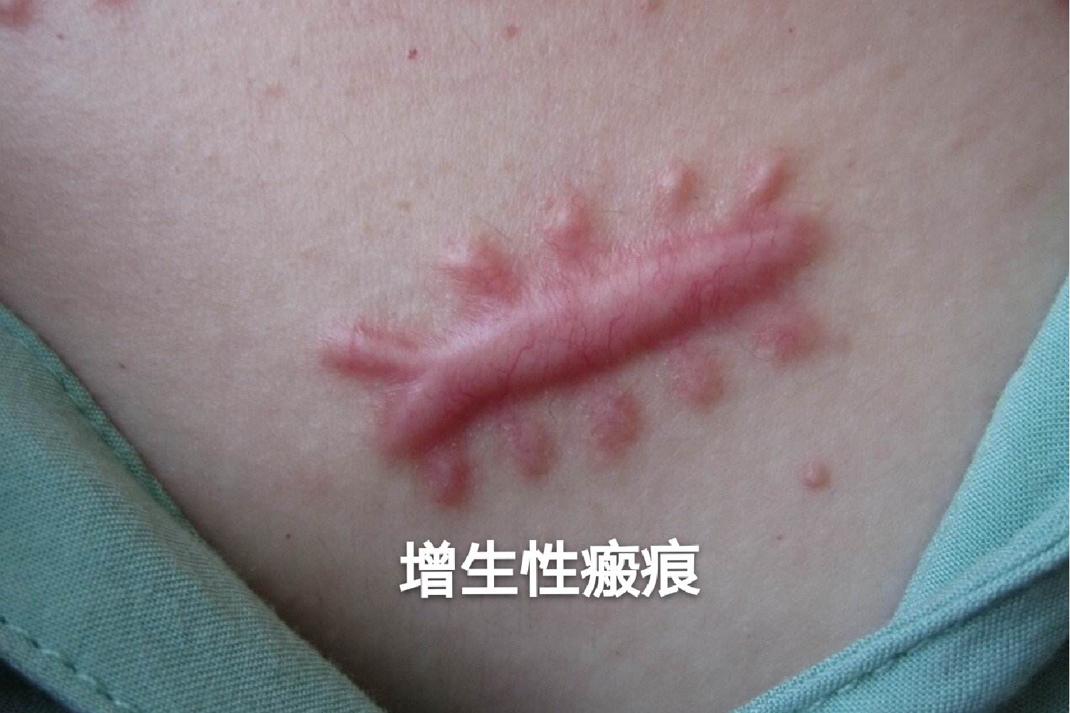 喉结切除术术后增生性瘢痕图片