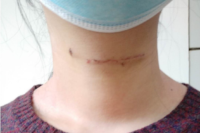 喉结切除术术后常规瘢痕图片