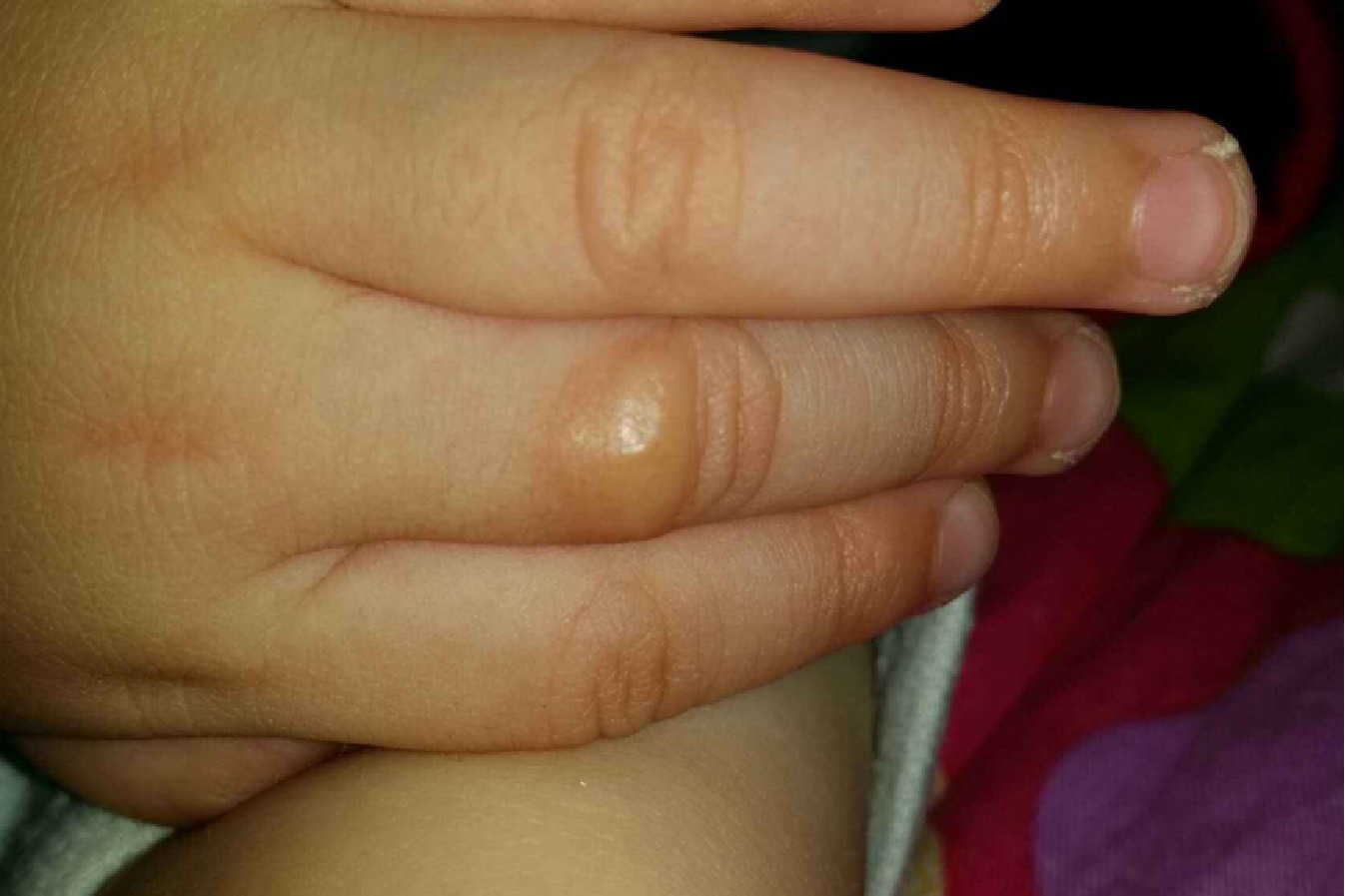 手指关节长脓包图片