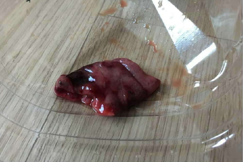 宫外孕手术取出孕囊图