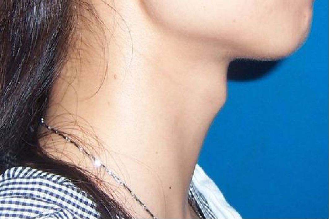女性喉结突出图