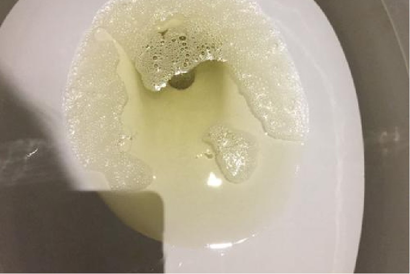 孕妇小便有泡沫图