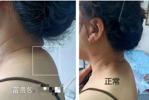 富贵包与正常对比图