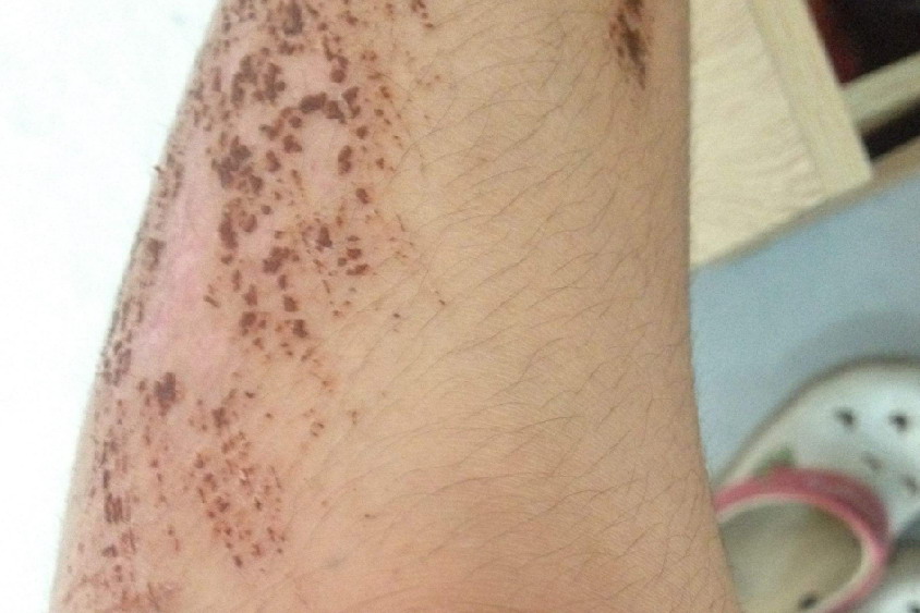 皮肤破了结痂图