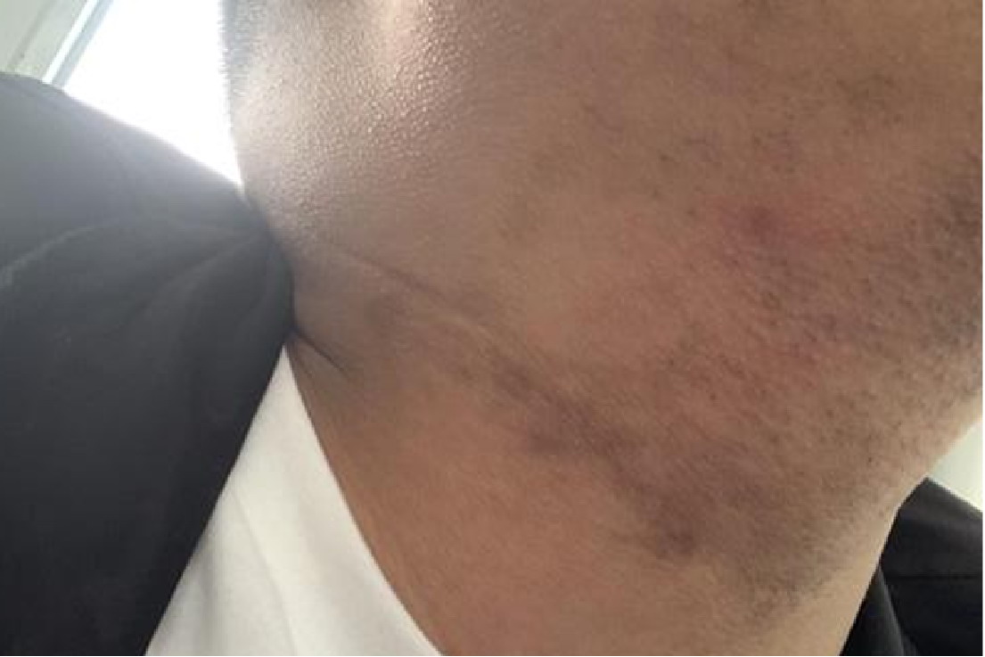 脖子黑色素沉淀图片