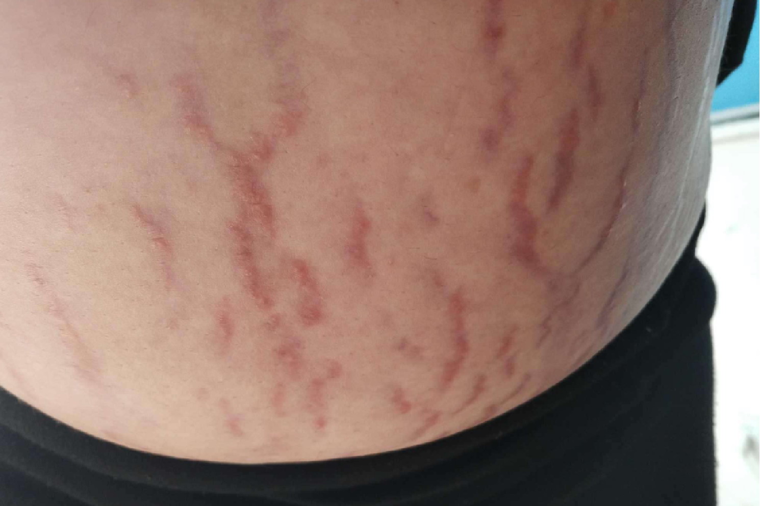 孕妇肚子有青筋图