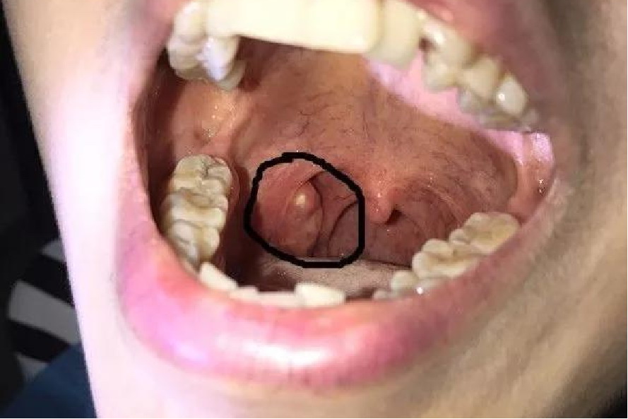 喉咙口有白色块状图片图片