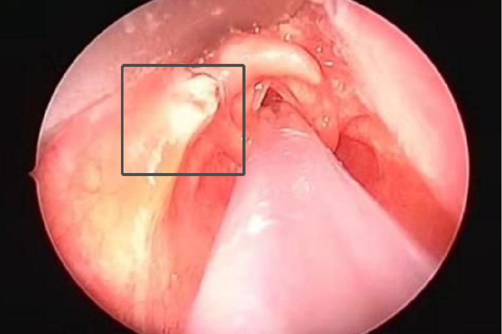 会厌囊肿白色凸起图片