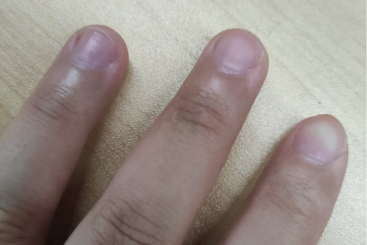 甲母痣术后恢复图