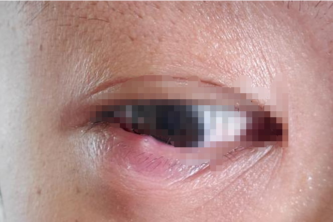 眼睛下面长脓包图