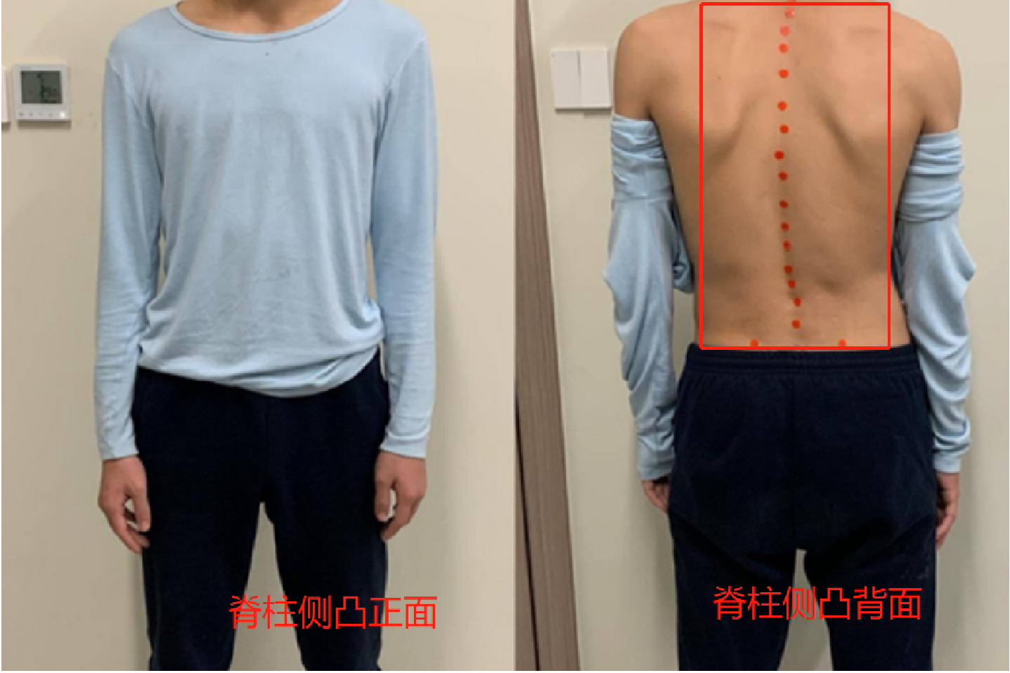 脊柱侧凸真人图片