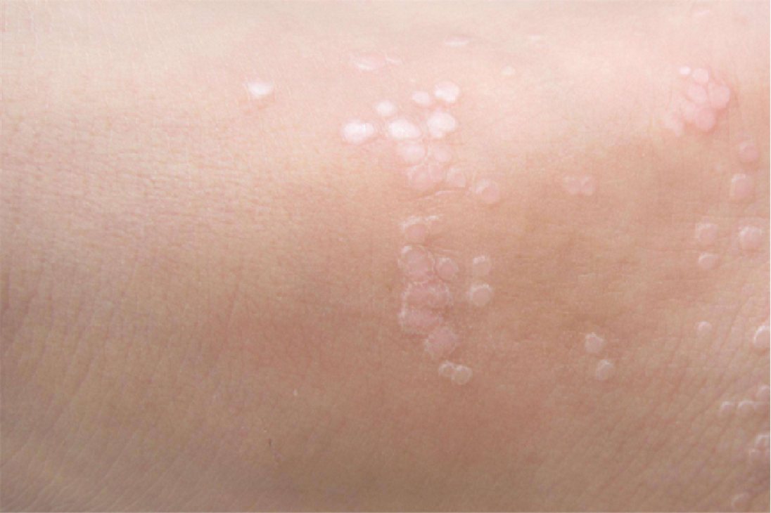 手上扁平疣图片