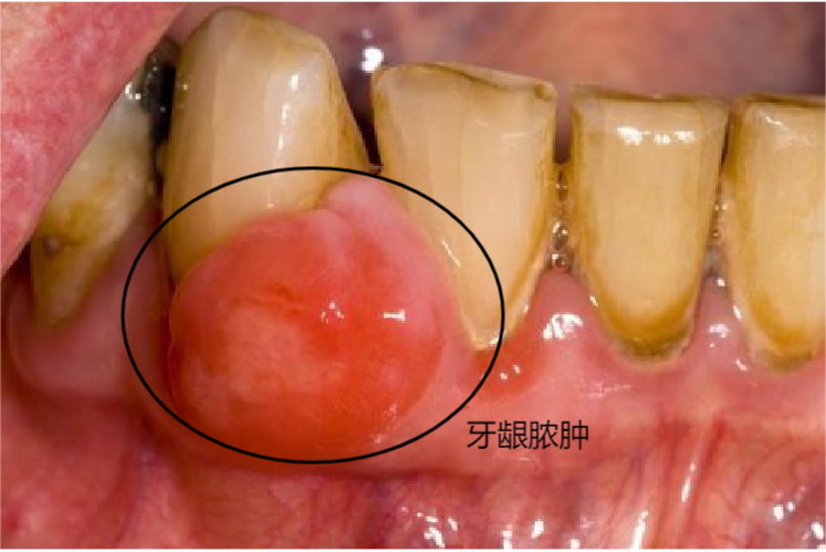 牙龈脓肿图片