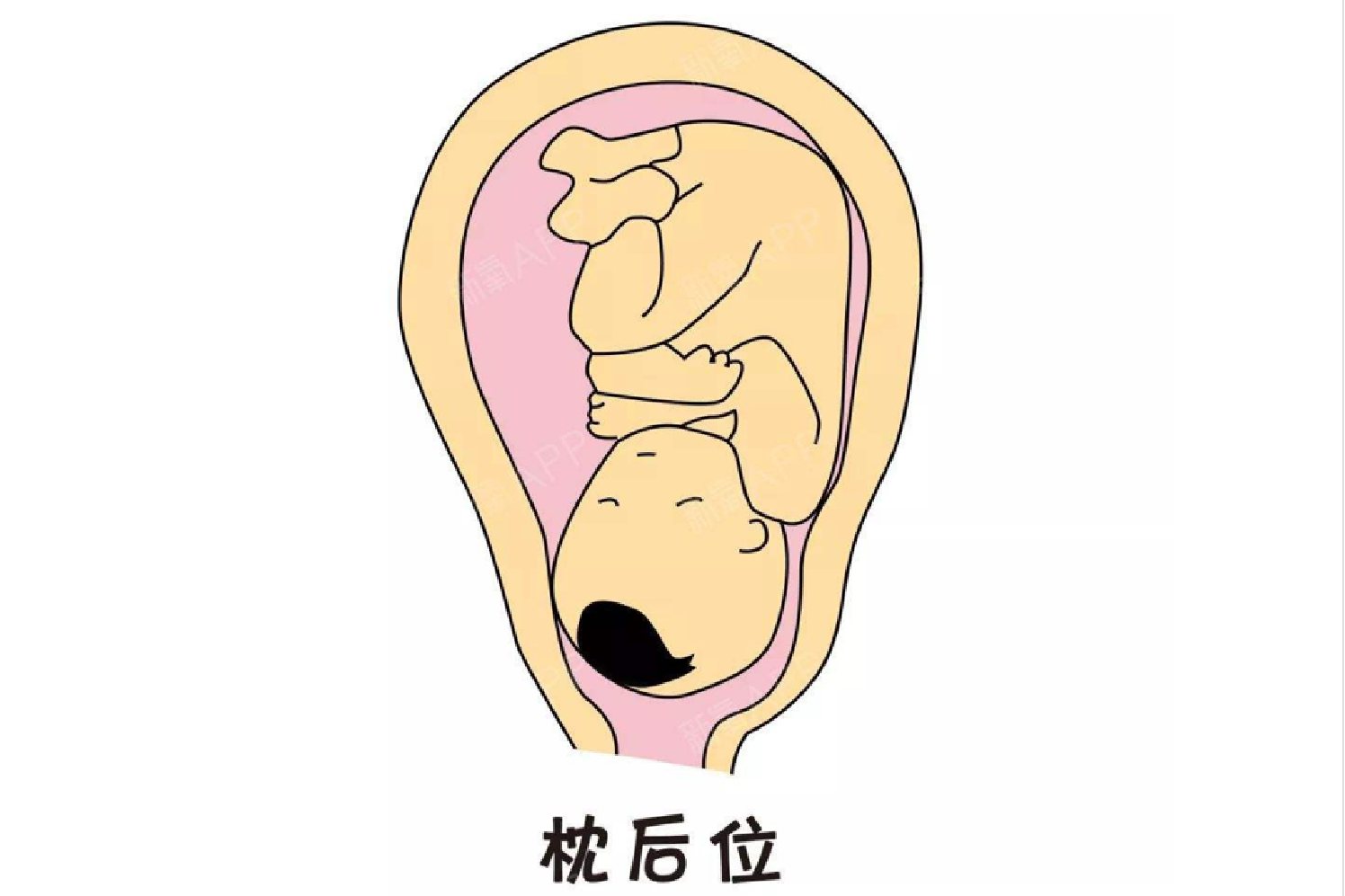 胎儿枕后位图片