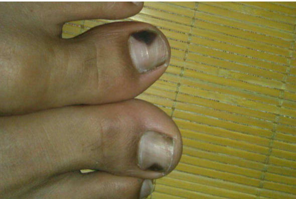 脚拇趾甲发紫图片