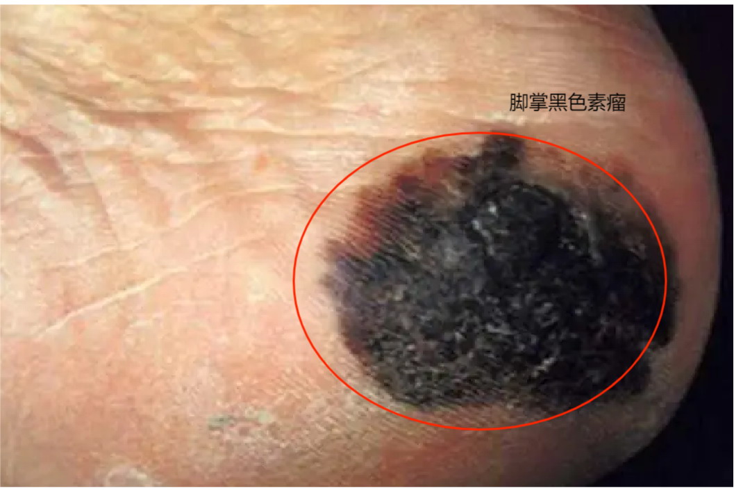 脚掌黑色素瘤图片
